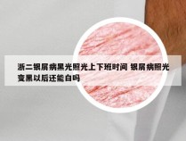 浙二银屑病黑光照光上下班时间 银屑病照光变黑以后还能白吗