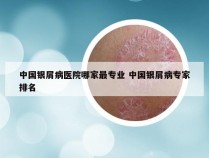 中国银屑病医院哪家最专业 中国银屑病专家排名