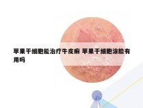 苹果干细胞能治疗牛皮癣 苹果干细胞涂脸有用吗