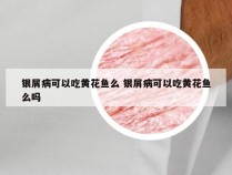 银屑病可以吃黄花鱼么 银屑病可以吃黄花鱼么吗