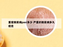 重度银屑病pasi多少 严重的银屑病多久痊愈