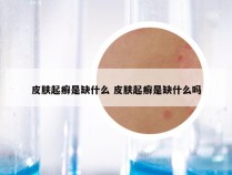 皮肤起癣是缺什么 皮肤起癣是缺什么吗