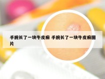手腕长了一块牛皮癣 手腕长了一块牛皮癣图片