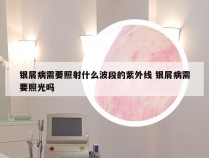 银屑病需要照射什么波段的紫外线 银屑病需要照光吗