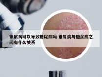 银屑病可以导致糖尿病吗 银屑病与糖尿病之间有什么关系