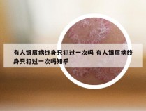 有人银屑病终身只犯过一次吗 有人银屑病终身只犯过一次吗知乎