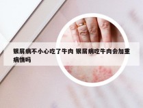 银屑病不小心吃了牛肉 银屑病吃牛肉会加重病情吗