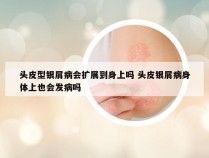 头皮型银屑病会扩展到身上吗 头皮银屑病身体上也会发病吗
