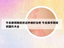 牛皮癣初期症状这种病好治吧 牛皮癣早期症状图片大全