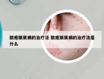 脓疱银屑病的治疗法 脓疱银屑病的治疗法是什么