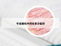 牛皮癣吃中药吃多少能好