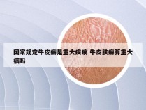 国家规定牛皮癣是重大疾病 牛皮肤癣算重大病吗