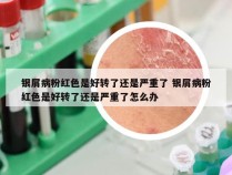 银屑病粉红色是好转了还是严重了 银屑病粉红色是好转了还是严重了怎么办