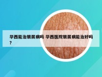华西能治银屑病吗 华西医院银屑病能治好吗?