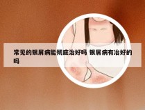 常见的银屑病能彻底治好吗 银屑病有冶好的吗
