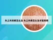 头上长的癣怎么治 头上长癣怎么治才能除根