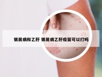 银屑病和乙肝 银屑病乙肝疫苗可以打吗
