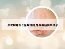 牛皮癣开始长是啥样的 牛皮癣起初的样子