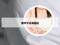 那种牛皮癣最轻