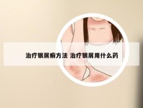 治疗银屑癣方法 治疗银屑用什么药