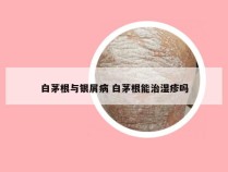 白茅根与银屑病 白茅根能治湿疹吗