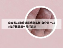 白介素17治疗银屑病怎么样 白介素一17a治疗银屑病一周打几次