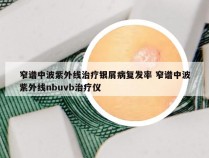 窄谱中波紫外线治疗银屑病复发率 窄谱中波紫外线nbuvb治疗仪