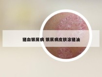 猪血银屑病 银屑病皮肤涂猪油