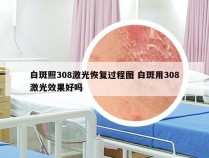 白斑照308激光恢复过程图 白斑用308激光效果好吗