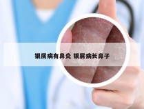 银屑病有鼻炎 银屑病长鼻子