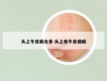 头上牛皮癣太多 头上有牛皮病癣