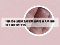 转移因子口服液治疗银屑病病吗 有人喝转移因子银屑病好的吗