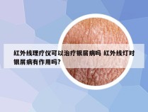 红外线理疗仪可以治疗银屑病吗 红外线灯对银屑病有作用吗?