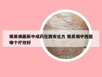 银屑病最新中成药在西安北方 银屑病中西医哪个疗效好