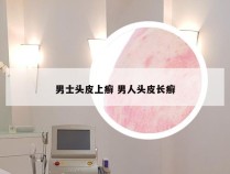男士头皮上癣 男人头皮长癣
