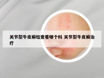 关节型牛皮癣检查看哪个科 关节型牛皮癣治疗