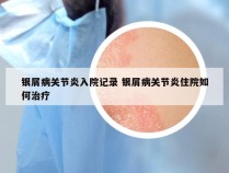 银屑病关节炎入院记录 银屑病关节炎住院如何治疗