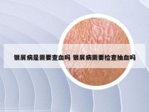 银屑病是需要查血吗 银屑病需要检查抽血吗
