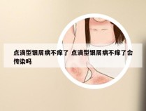 点滴型银屑病不痒了 点滴型银屑病不痒了会传染吗