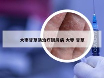 大枣甘草汤治疗银屑病 大枣 甘草