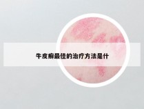 牛皮癣最佳的治疗方法是什