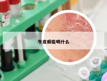 牛皮癣能喝什么