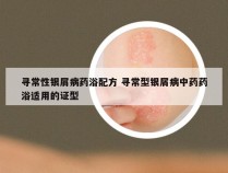寻常性银屑病药浴配方 寻常型银屑病中药药浴适用的证型