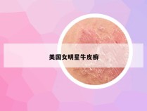 美国女明星牛皮癣