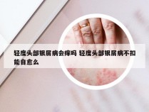 轻度头部银屑病会痒吗 轻度头部银屑病不扣能自愈么