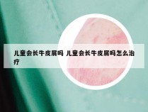 儿童会长牛皮屑吗 儿童会长牛皮屑吗怎么治疗