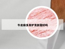 牛皮癣多用护发肤霜好吗