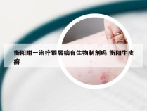衡阳附一治疗银屑病有生物制剂吗 衡阳牛皮癣