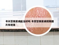 寻长型银屑病能治好吗 寻常型银屑病初期图片和现象