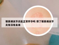 银屑病关节炎能正常怀孕吗 得了银屑病关节炎有没有未来